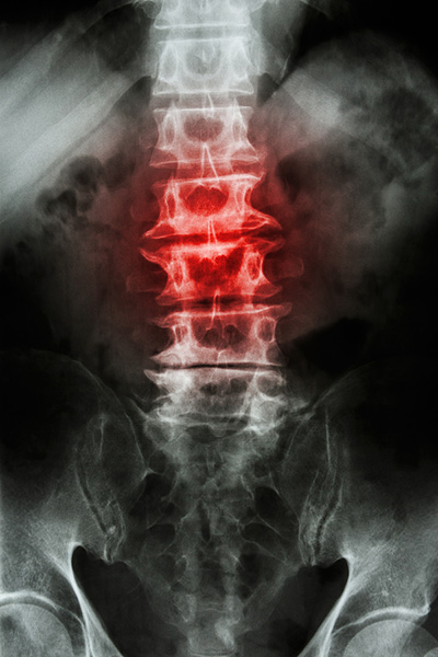 Spine x-ray showing pain